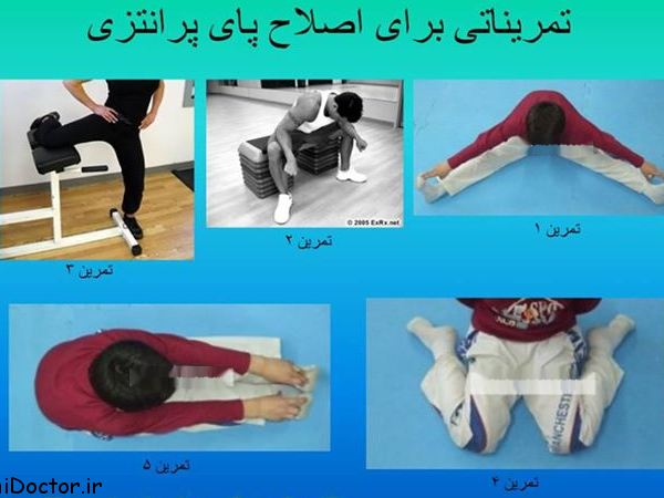 ورزشی مخصوص زانوی پرانتزی