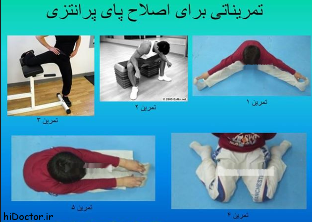 ورزشی مخصوص زانوی پرانتزی