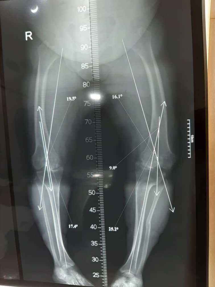بیمار با مشکل آرتروز شدید زانو و مشکل تغییر شکل مادرزادی شدید زانو