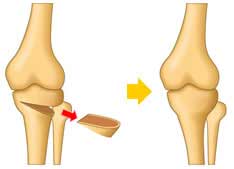استئوتومی 