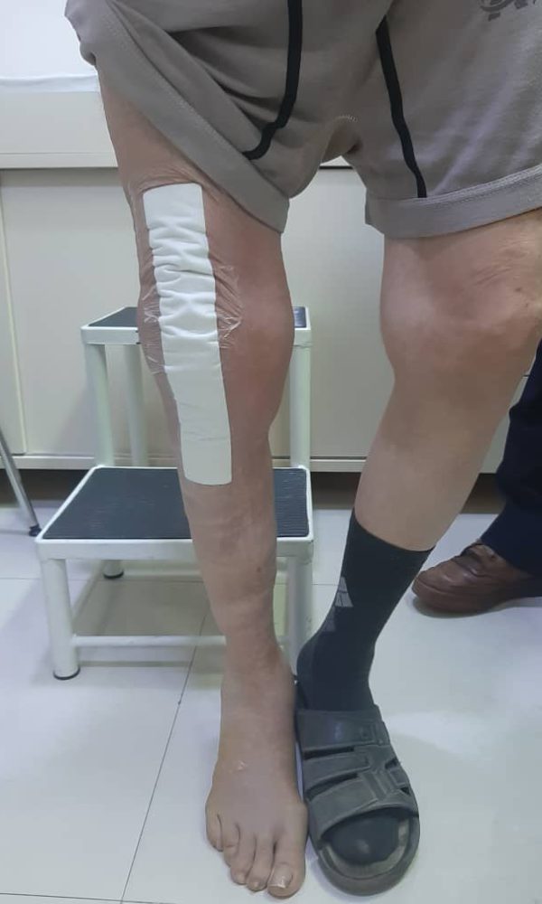 عمل تعویض مفصل زانو ( 10 روز پس از عمل )