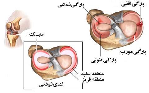 علائم آسیب‌دیدگی منیسک