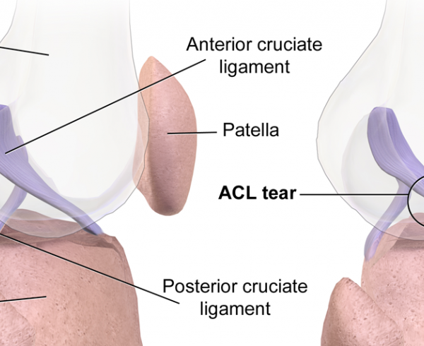 رباط صلیبی قدامی ACL در مفصل زانو چگونه آسیب دیده و علائم پارگی آن چیست