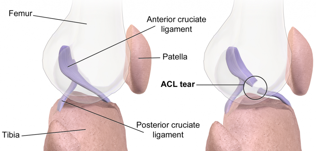 رباط صلیبی قدامی ACL در مفصل زانو چگونه آسیب دیده و علائم پارگی آن چیست