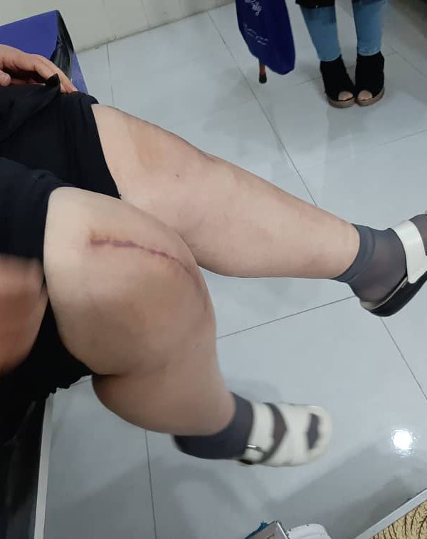 جراحی تعویض مفصل هر دو زانو همزمان بعد از یک ماه