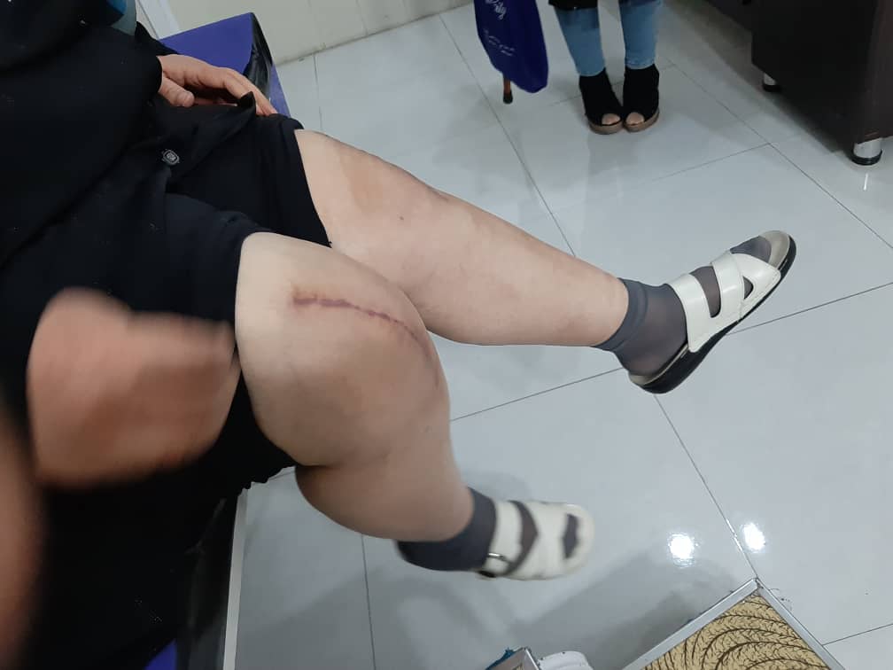 جراحی تعویض مفصل هر دو زانو همزمان بعد از یک ماه