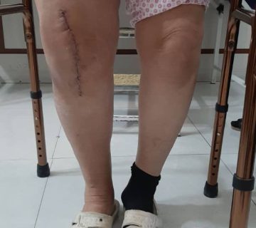 خانم ۷۰ ساله یک هفته بعد از عمل
