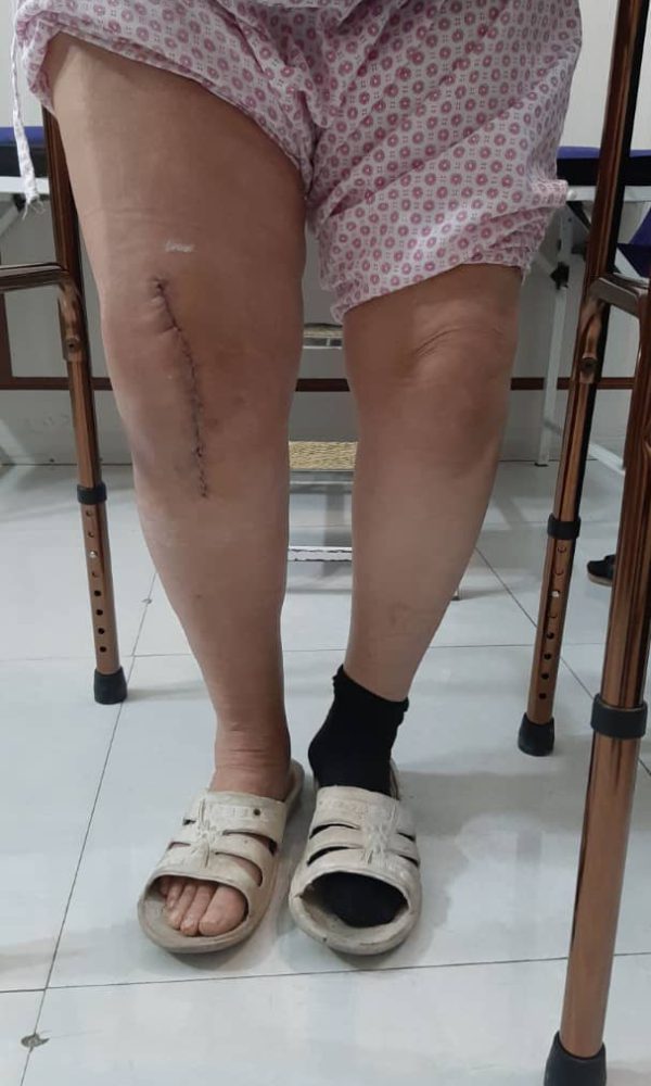 خانم ۷۰ ساله یک هفته بعد از عمل