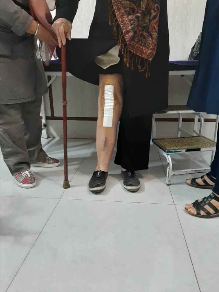 خانم ۸۵ ساله با ارتروز 