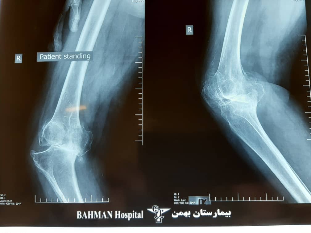 خانم مسن مبتلا به ارتروز شدید