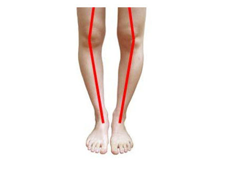علل به وجود آمدن زانوی پرانتزی و حرکات اصلاحی آن