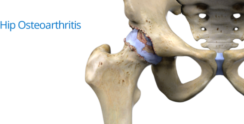 آرتروز مفصل ران Hip osteoarthritis معمولا زودتر رخ می دهد