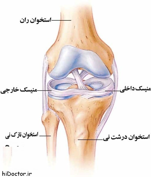 پارگی منیسک