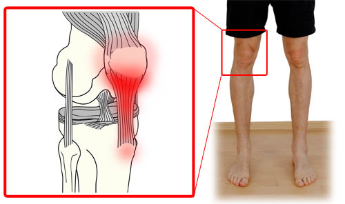پارگی تاندون کشکک چگونه ایجاد میشود؟