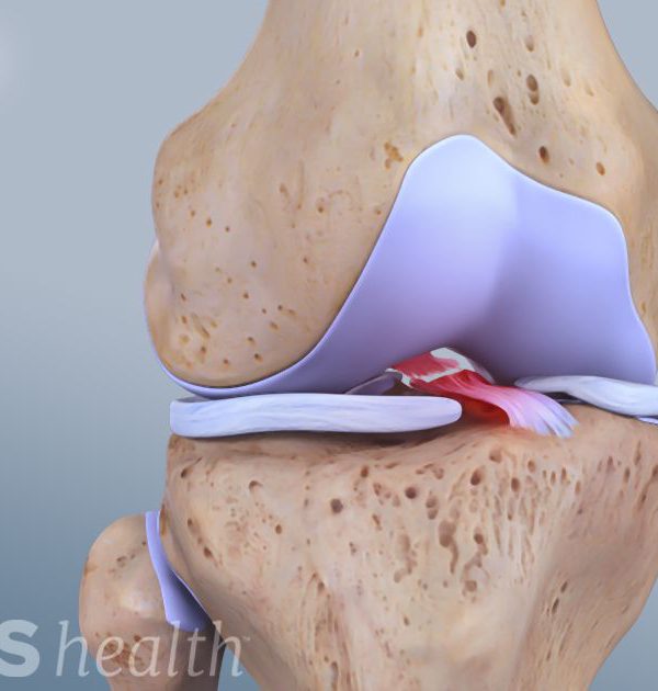 توانبخشی و درمان آسیب رباط ACL