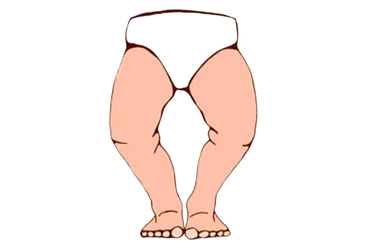 چه چیزی باعث پای پرانتزی می شود؟