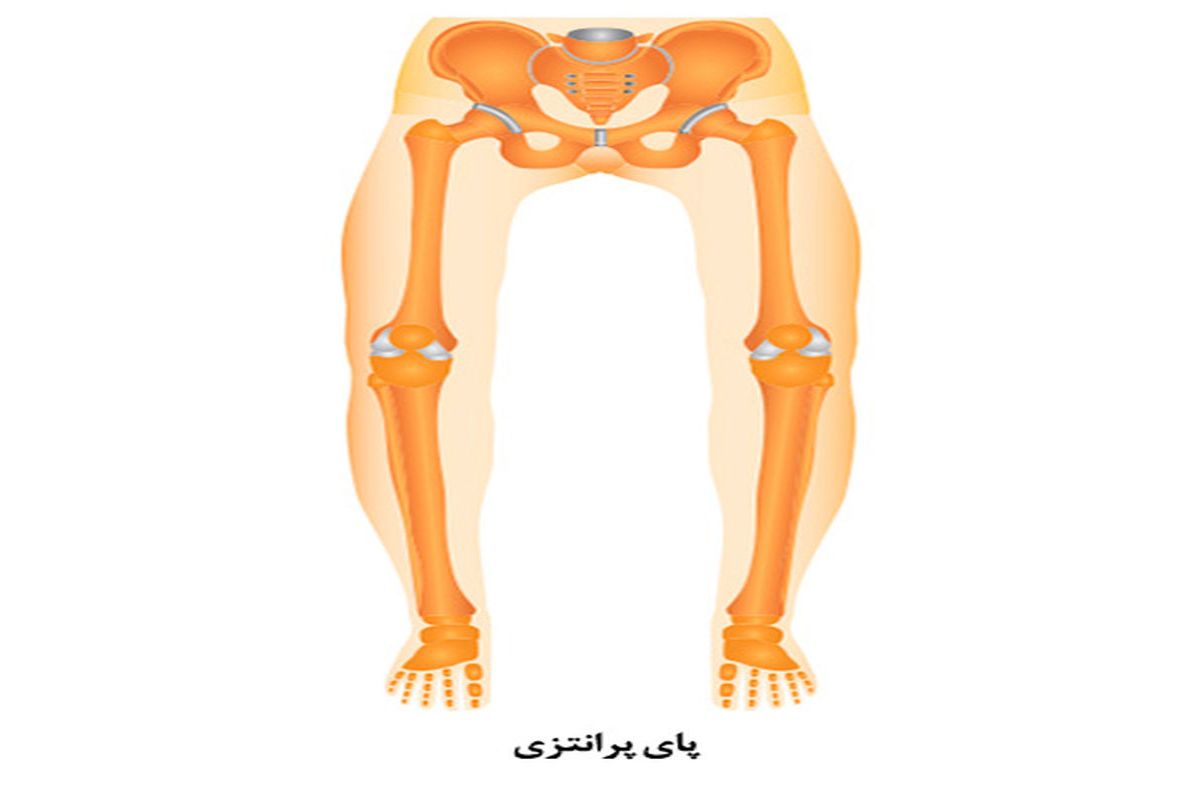  ایکس و دیگر اختلالات حرکتی
