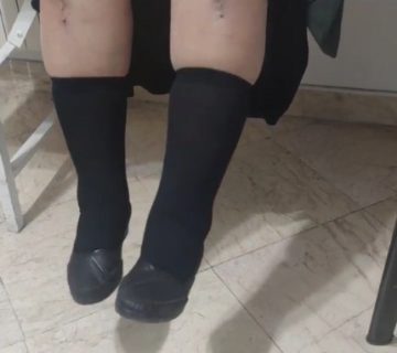 تجربه بیمار بعد عمل هم زمان هر دو زانو